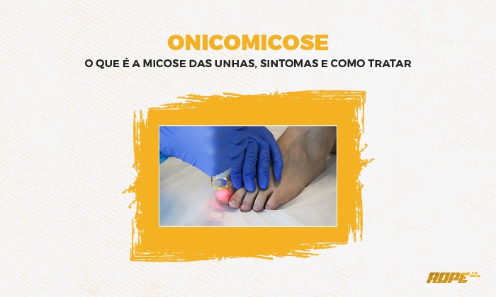 Onicomicose: o que é a micose das unhas, sintomas e como tratar